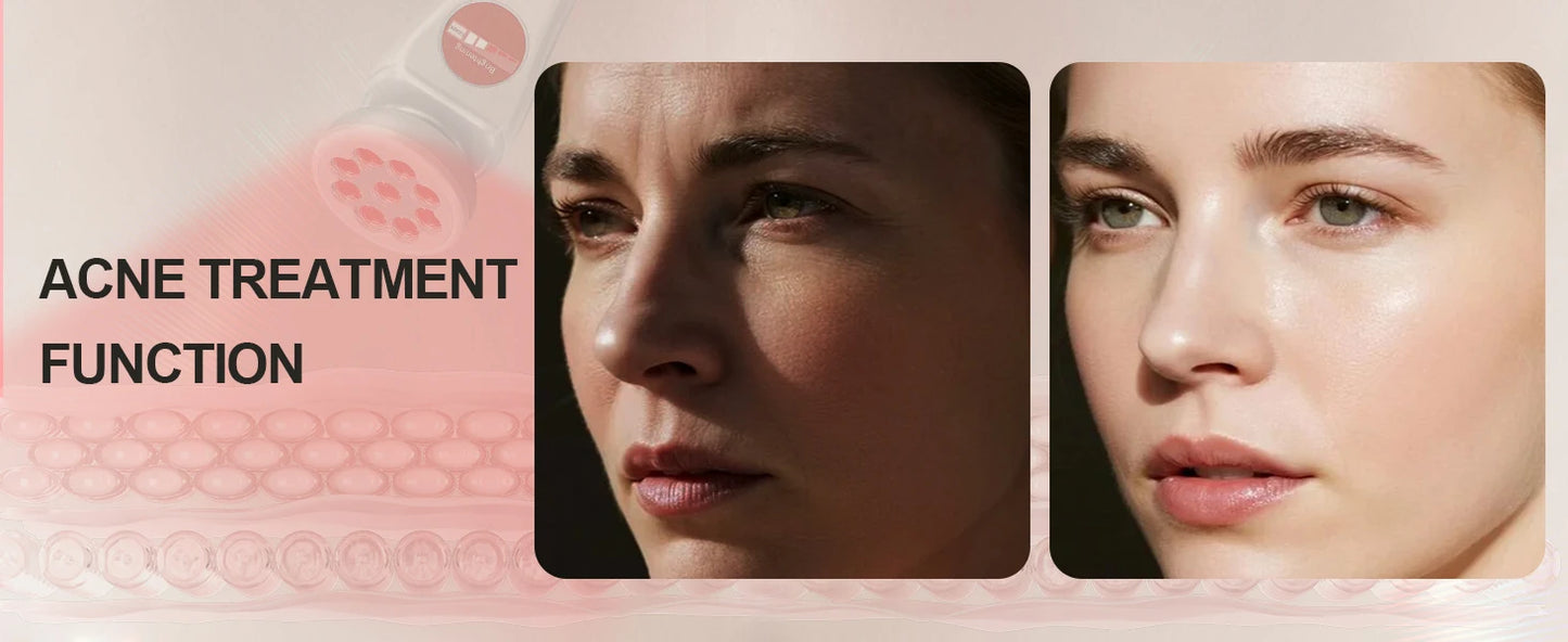 Kompakter, multifunktionaler Phototherapie-Detektor für Kosmetikprodukte der Unterhaltungselektronik, einschließlich Aknebehandlung und Hautaufhellung